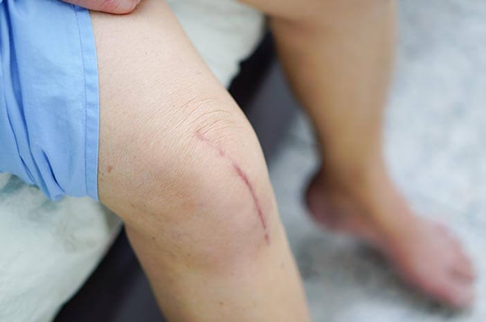 5 Pengobatan Rumahan untuk Atasi Infeksi Luka Operasi