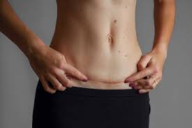 Merawat Luka Operasi Caesar