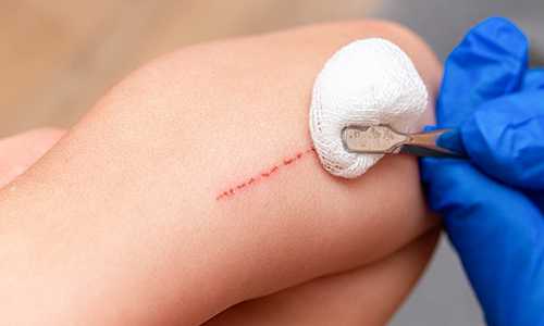 Apakah Bekas Luka Dapat Hilang?