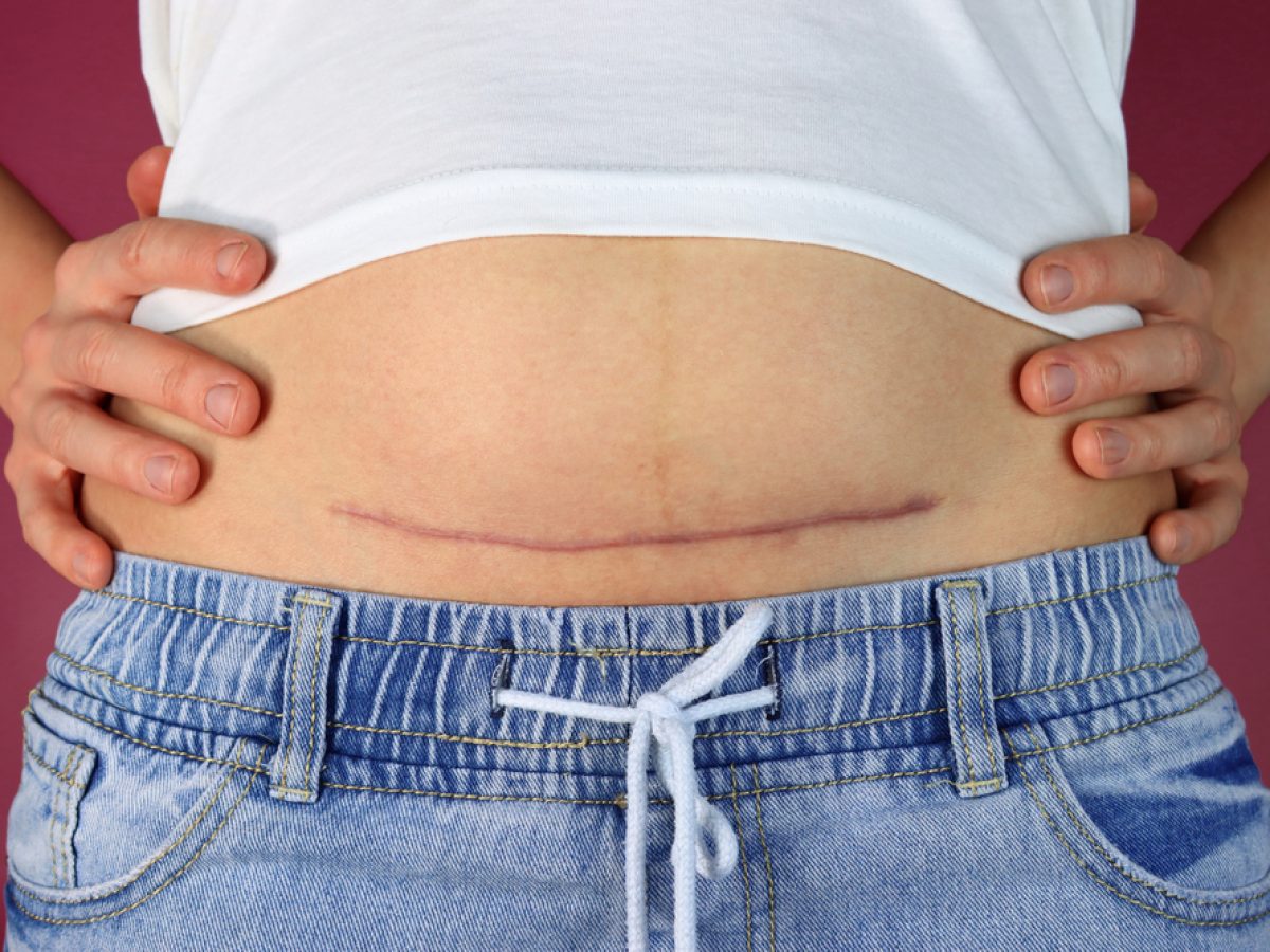 Ciri Infeksi pada Luka Caesar Bagian Dalam dan Cara Mencegahnya