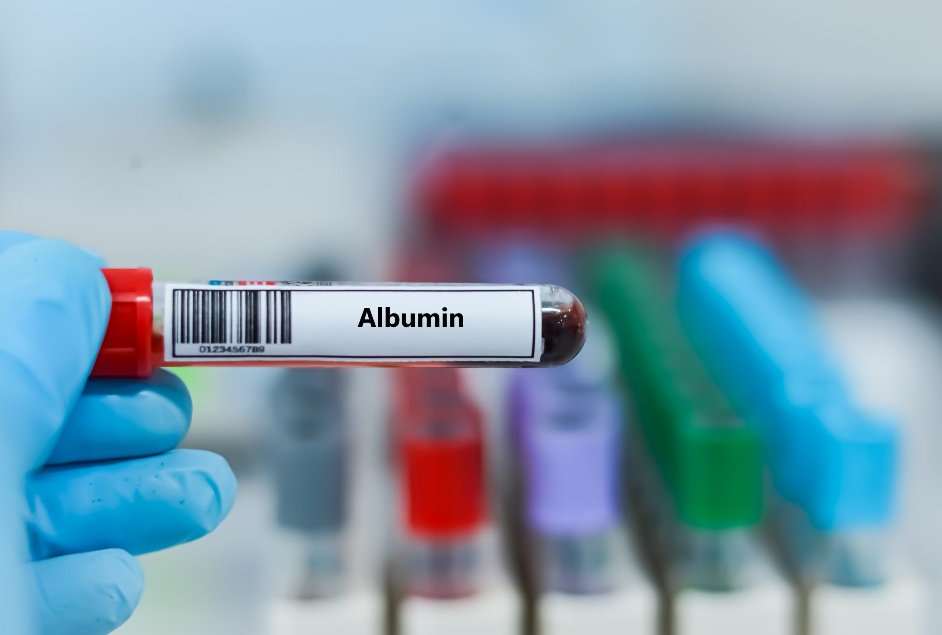 Albumin in Therapeutic Plasma Exchange: What Patients Should Know